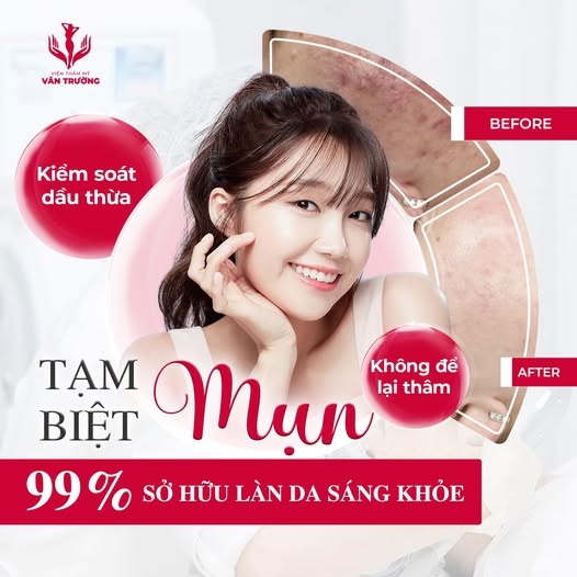 điều trị mụn