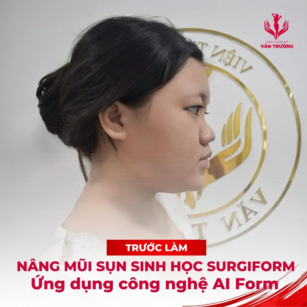 mũi surgiform 1