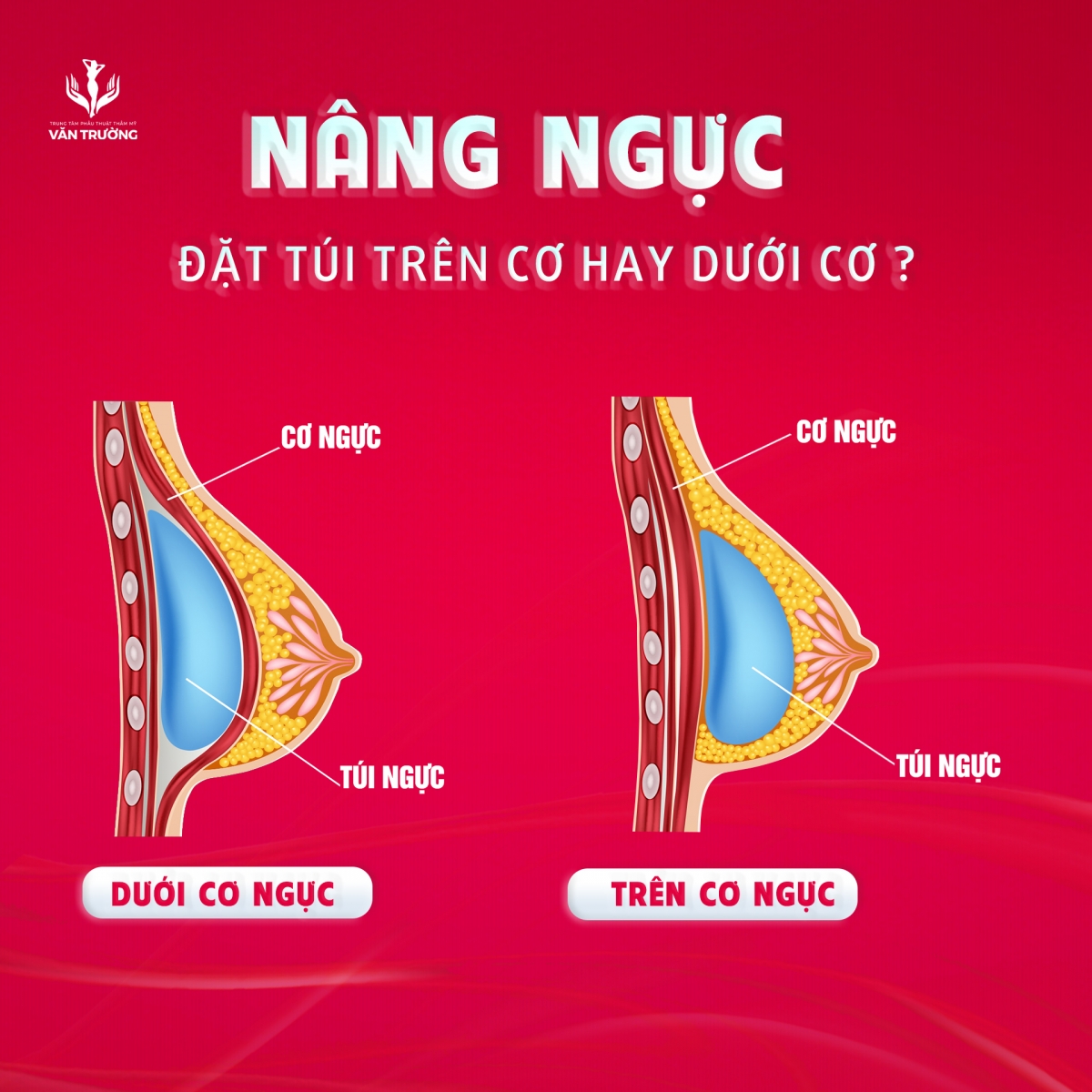 nâng ngực đặt túi trên cơ hay dưới cơ