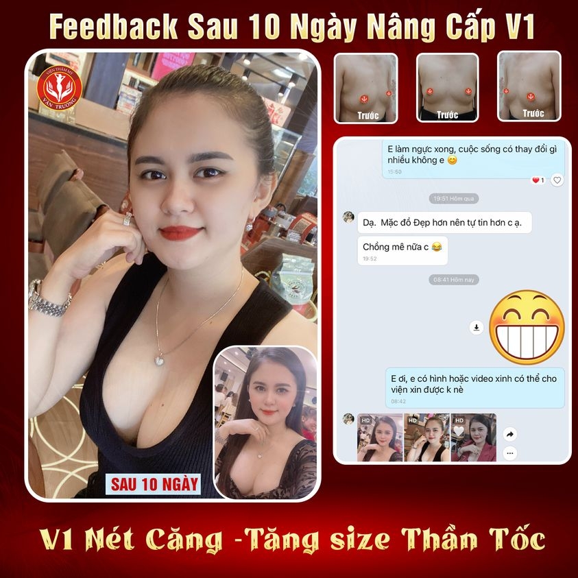 nâng ngực sau 10 ngày